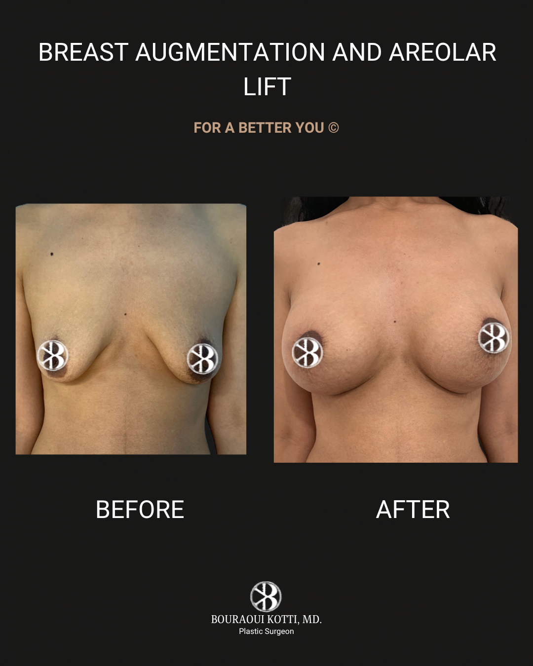 Breast Augmentation after Dubai