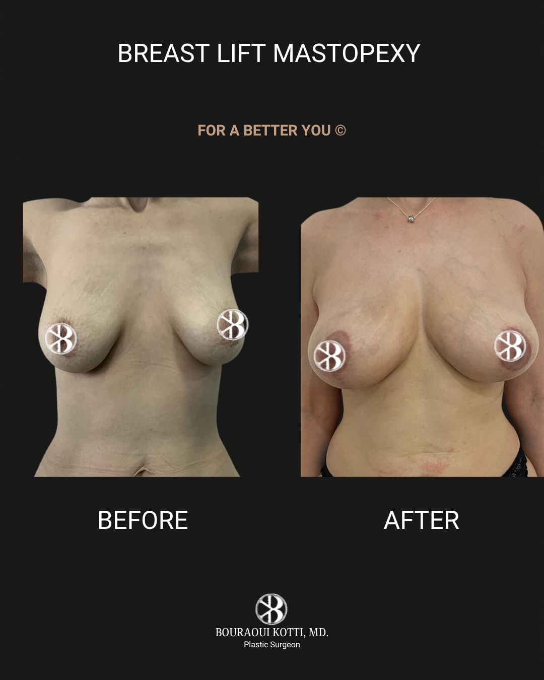 Breast Lift (Mastopexy) after Dubai