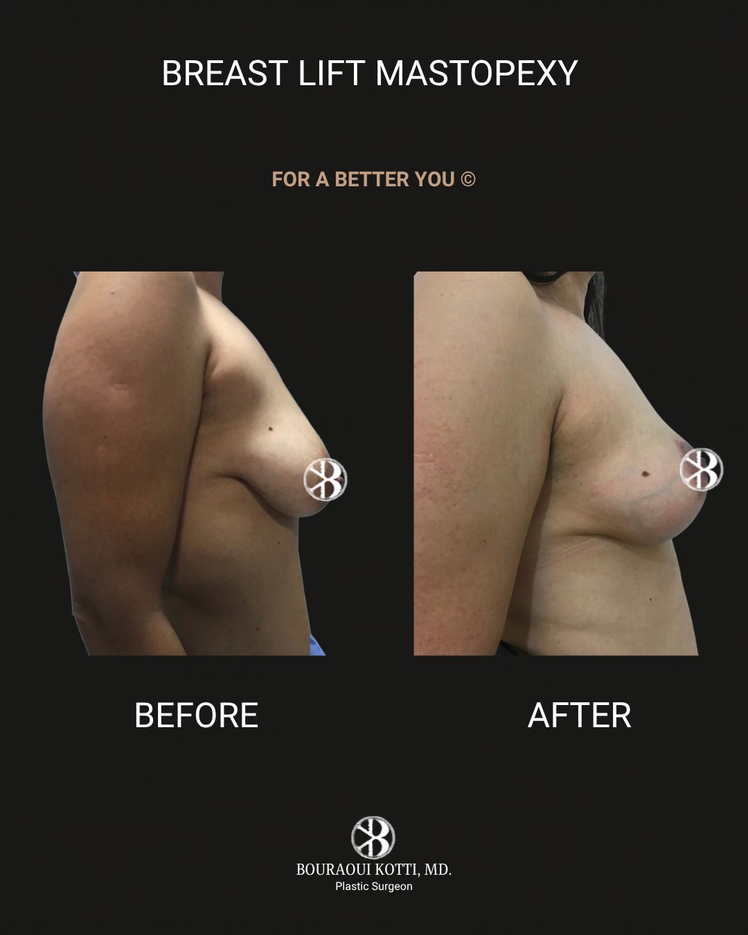 Breast Lift (Mastopexy) before Dubai