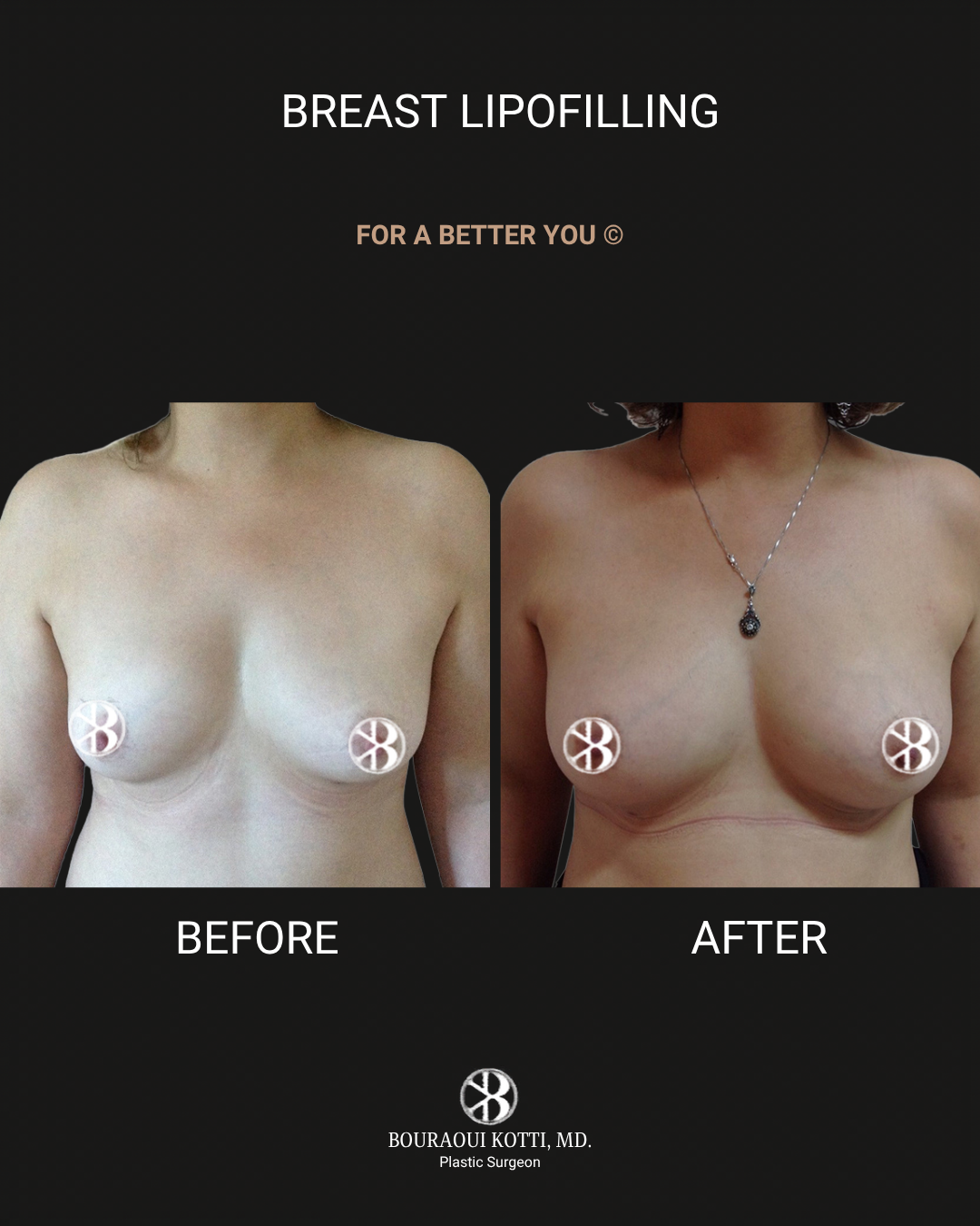 حقن وتشكيل الثدي بالدهون (Breast Lipomodelling) before Dubai