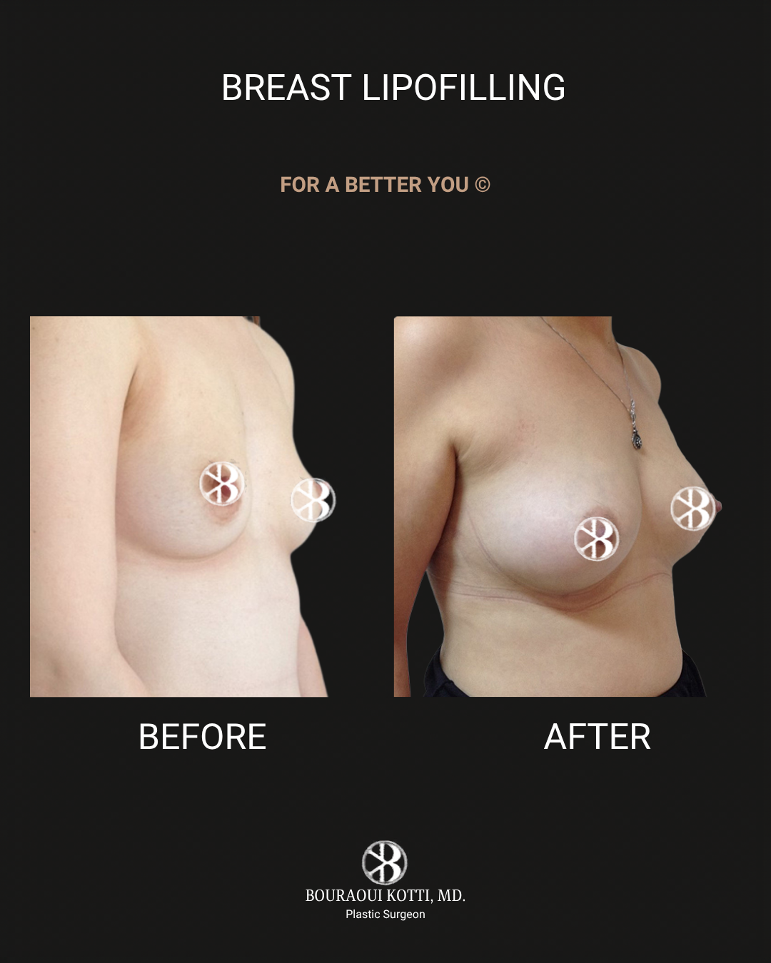 حقن وتشكيل الثدي بالدهون (Breast Lipomodelling) after Dubai