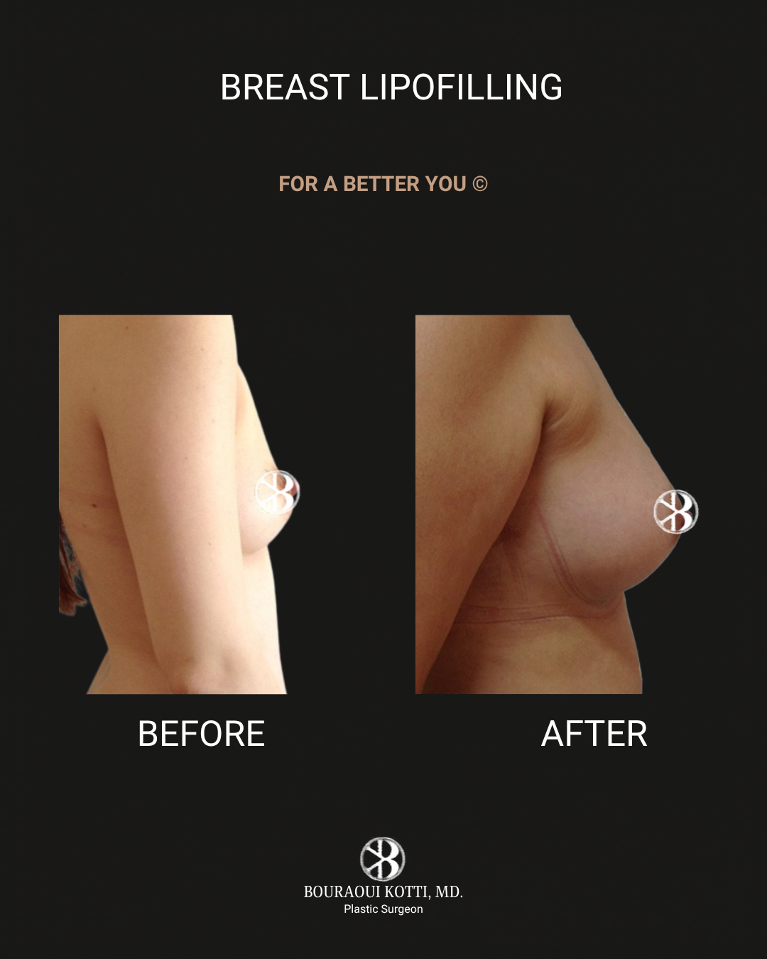 حقن وتشكيل الثدي بالدهون (Breast Lipomodelling) before Dubai