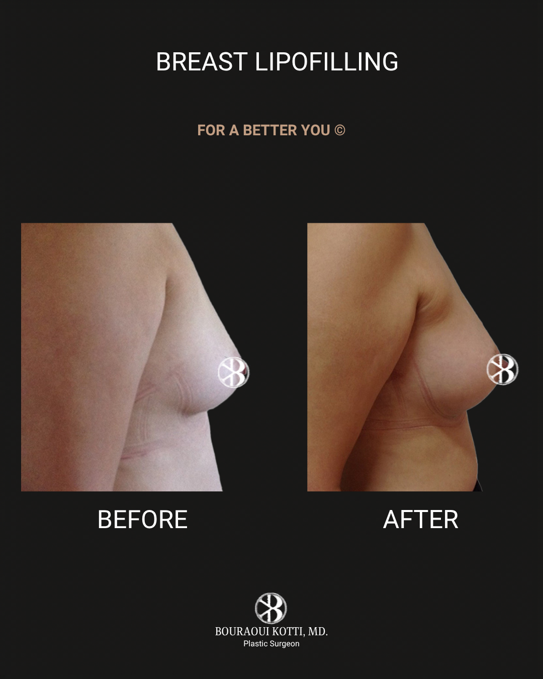 حقن وتشكيل الثدي بالدهون (Breast Lipomodelling) after Dubai