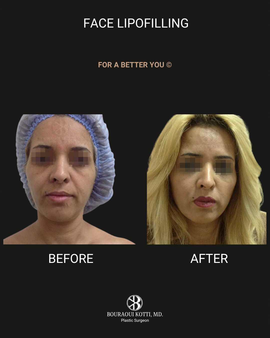 حقن الدهون الذاتية للوجه before Dubai