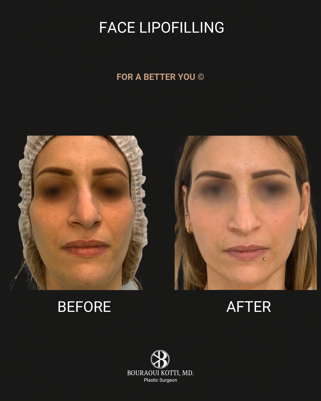 حقن الدهون الذاتية للوجه after Dubai