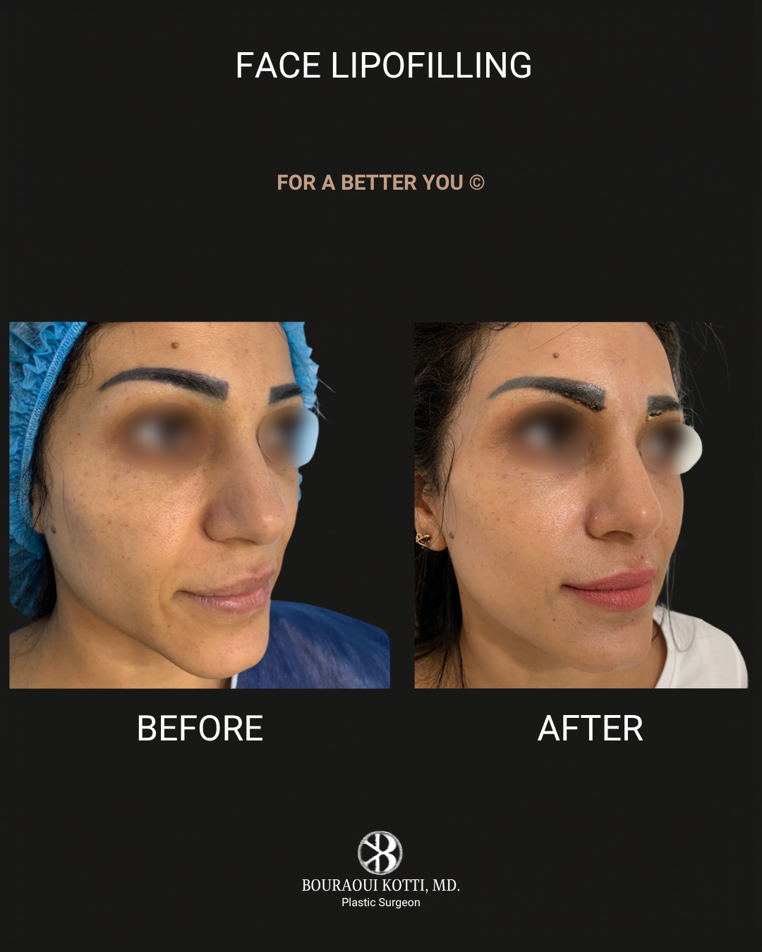 حقن الدهون الذاتية للوجه before Dubai