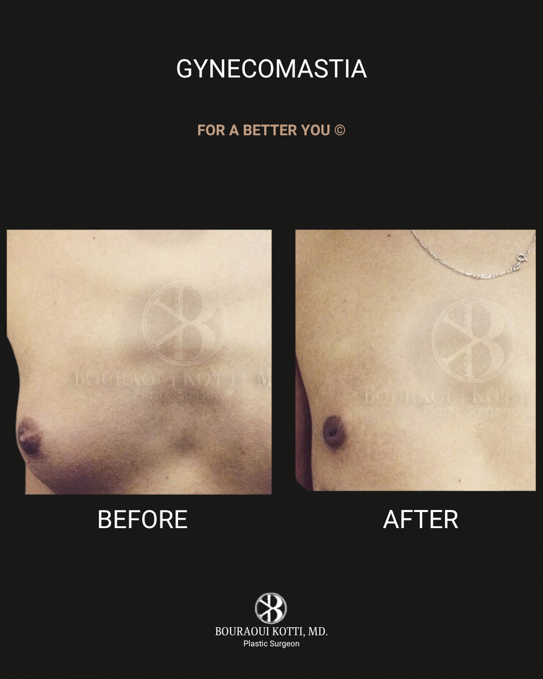 Male Breast Reduction (Gynecomastia) before Dubai