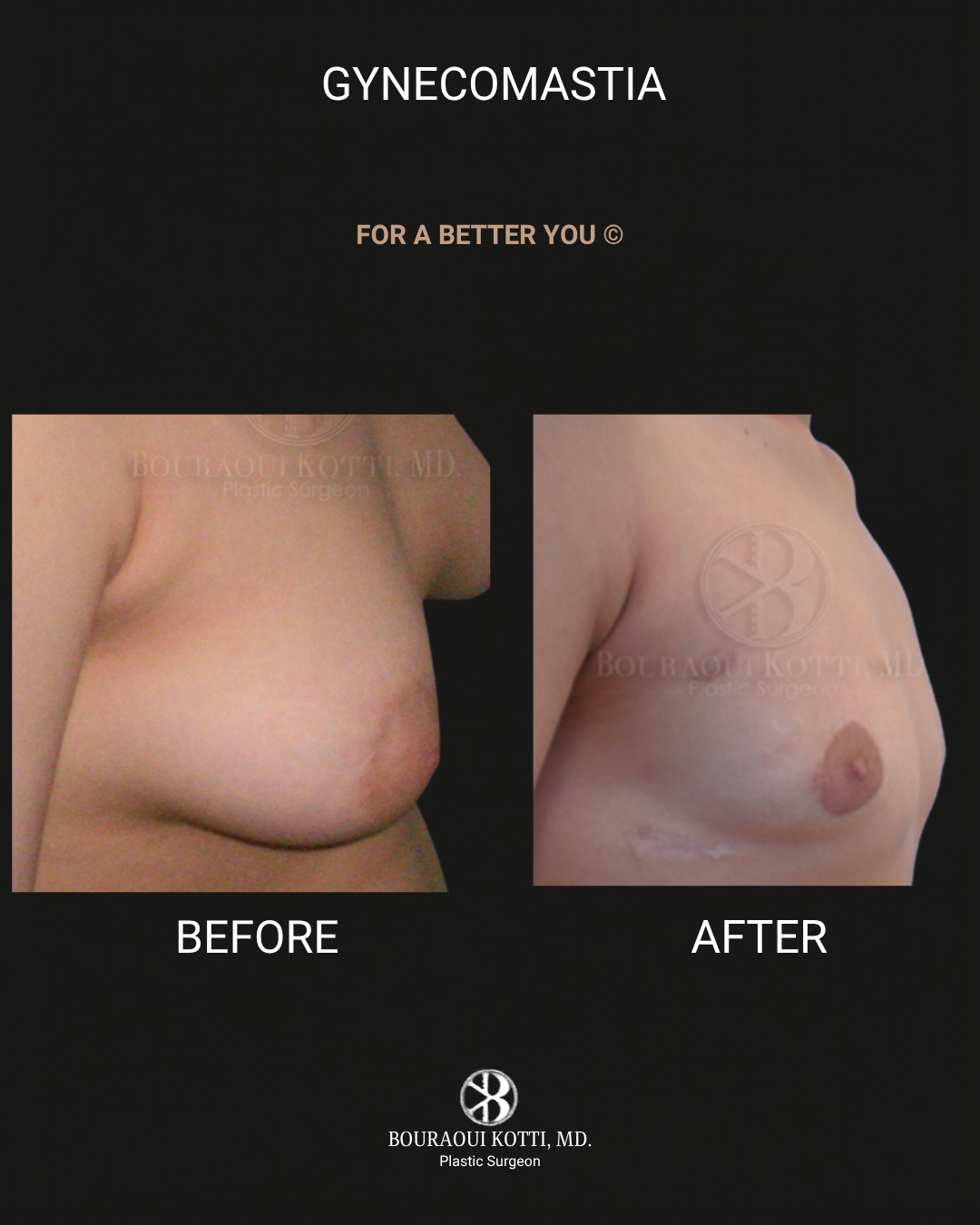 Male Breast Reduction (Gynecomastia) after Dubai