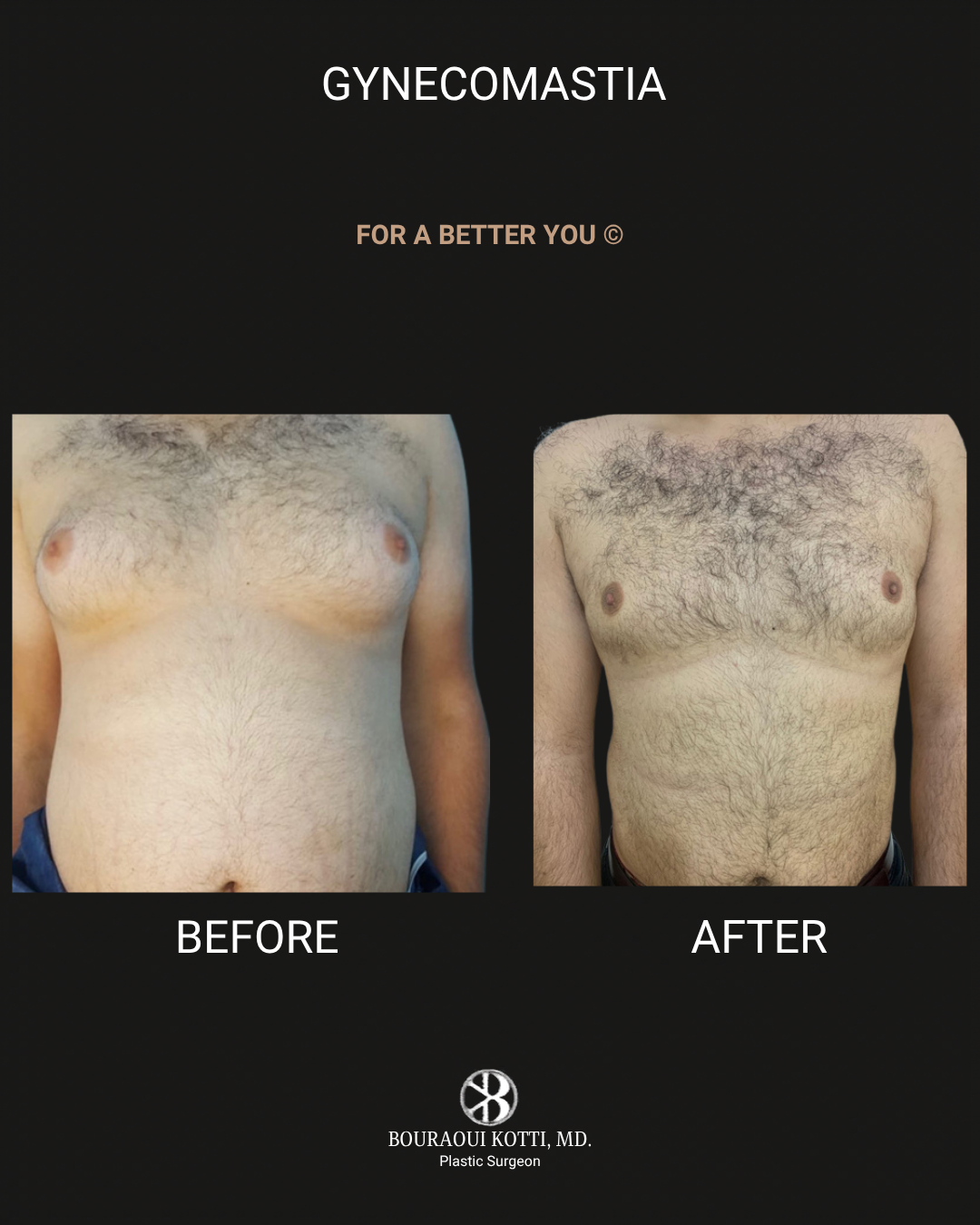 Male Breast Reduction (Gynecomastia) before Dubai