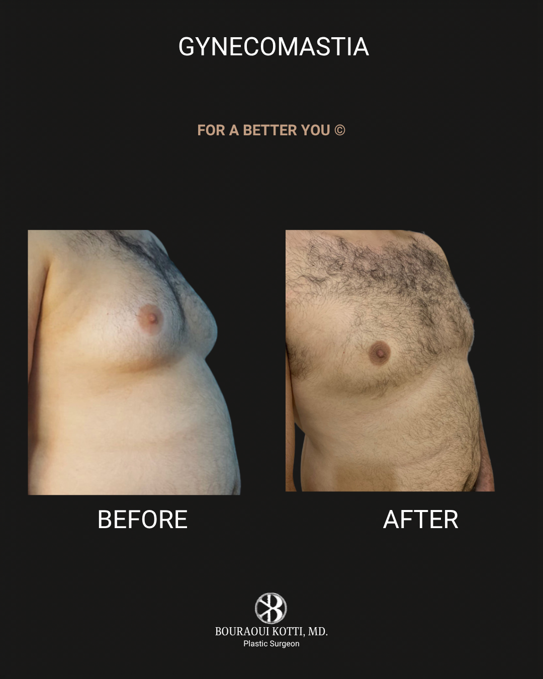 Male Breast Reduction (Gynecomastia) after Dubai