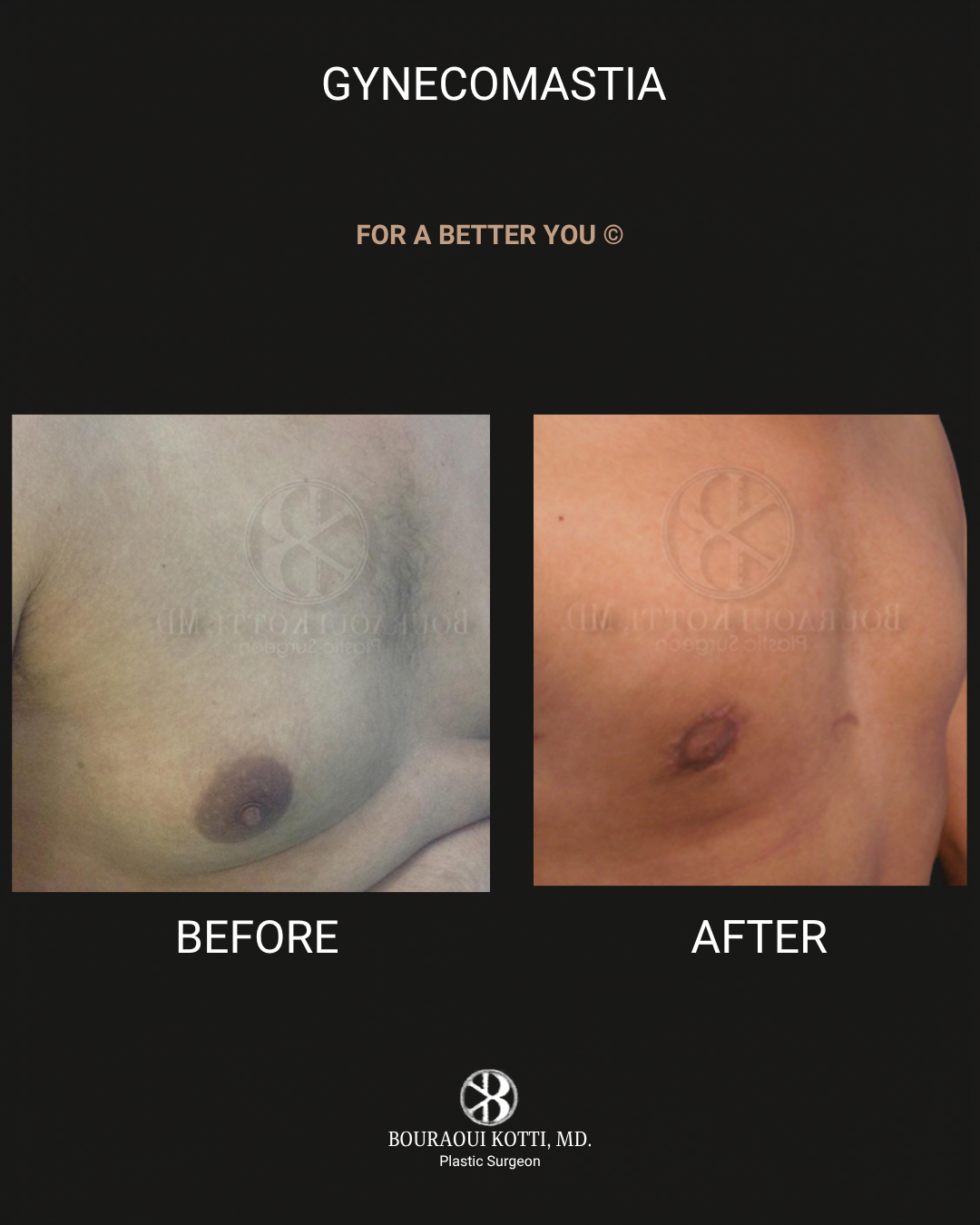 Male Breast Reduction (Gynecomastia) before Dubai