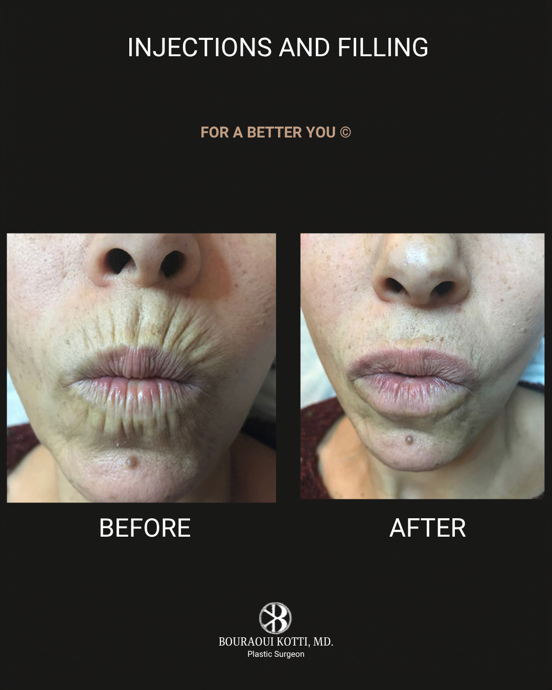 Lip Filler (Hyaluronic Acid) before Dubai