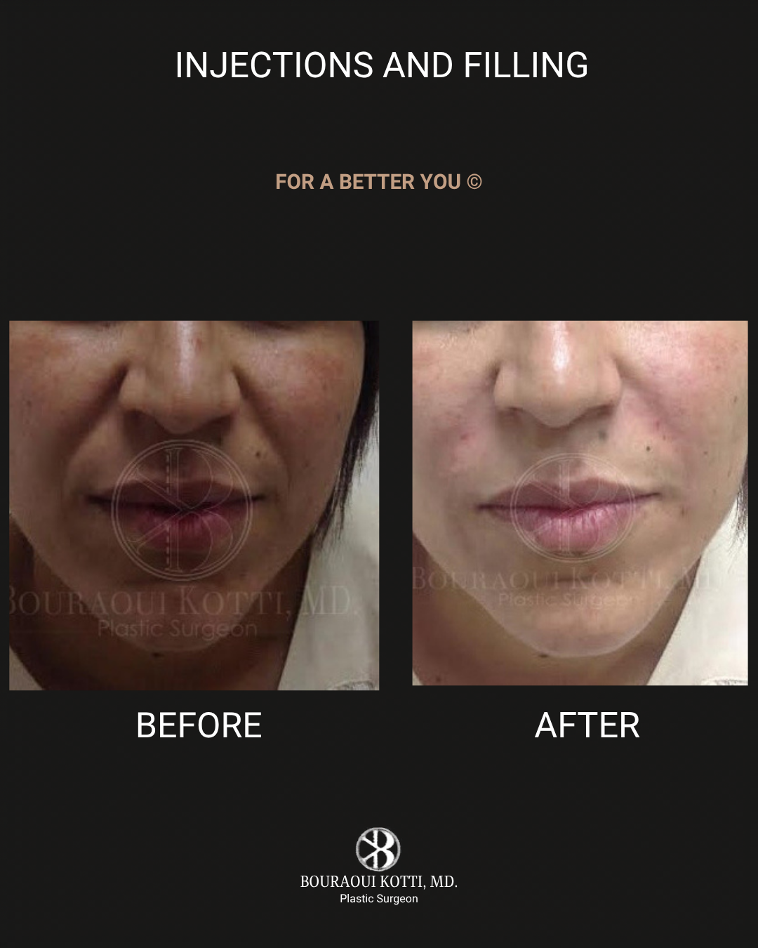 Lip Filler (Hyaluronic Acid) after Dubai