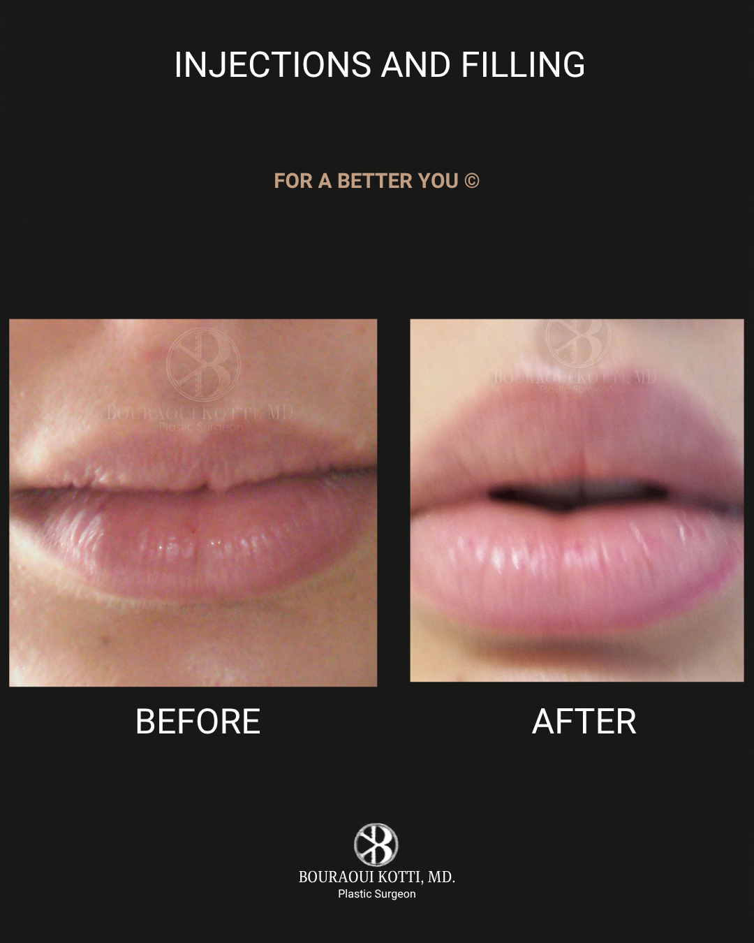 Lip Filler (Hyaluronic Acid) before Dubai