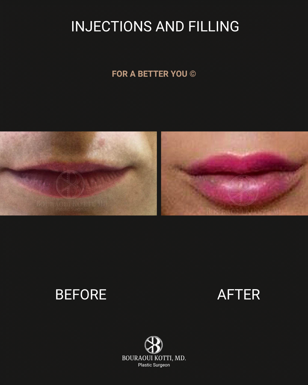 Lip Filler (Hyaluronic Acid) after Dubai