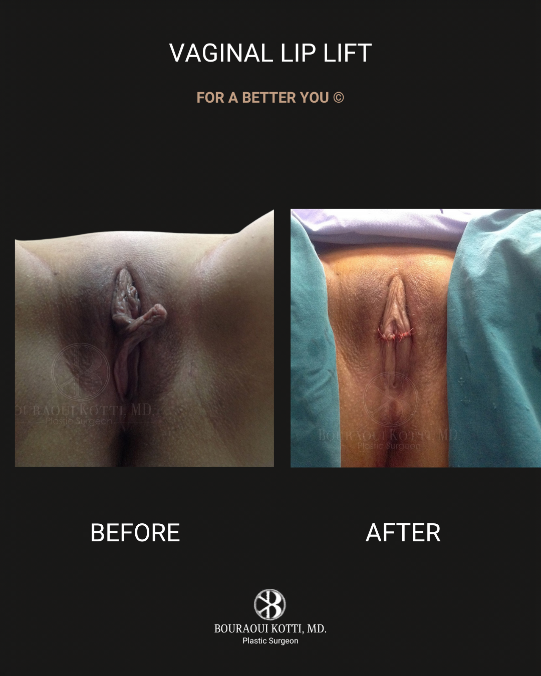 Labiaplasty in Dubai before Dubai