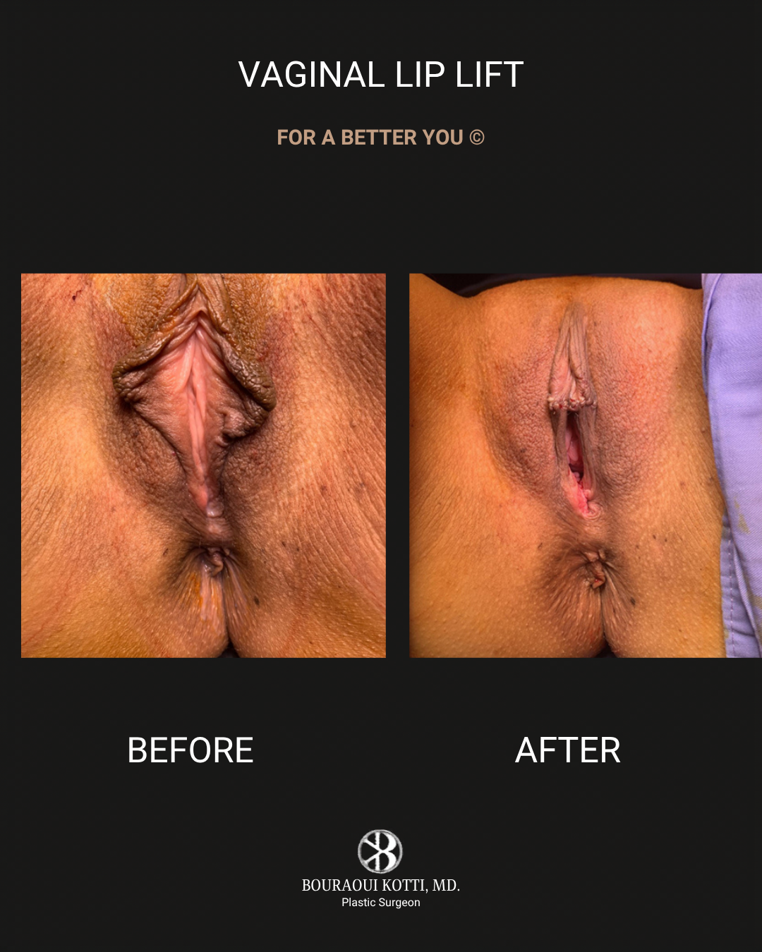 Labiaplasty in Dubai after Dubai