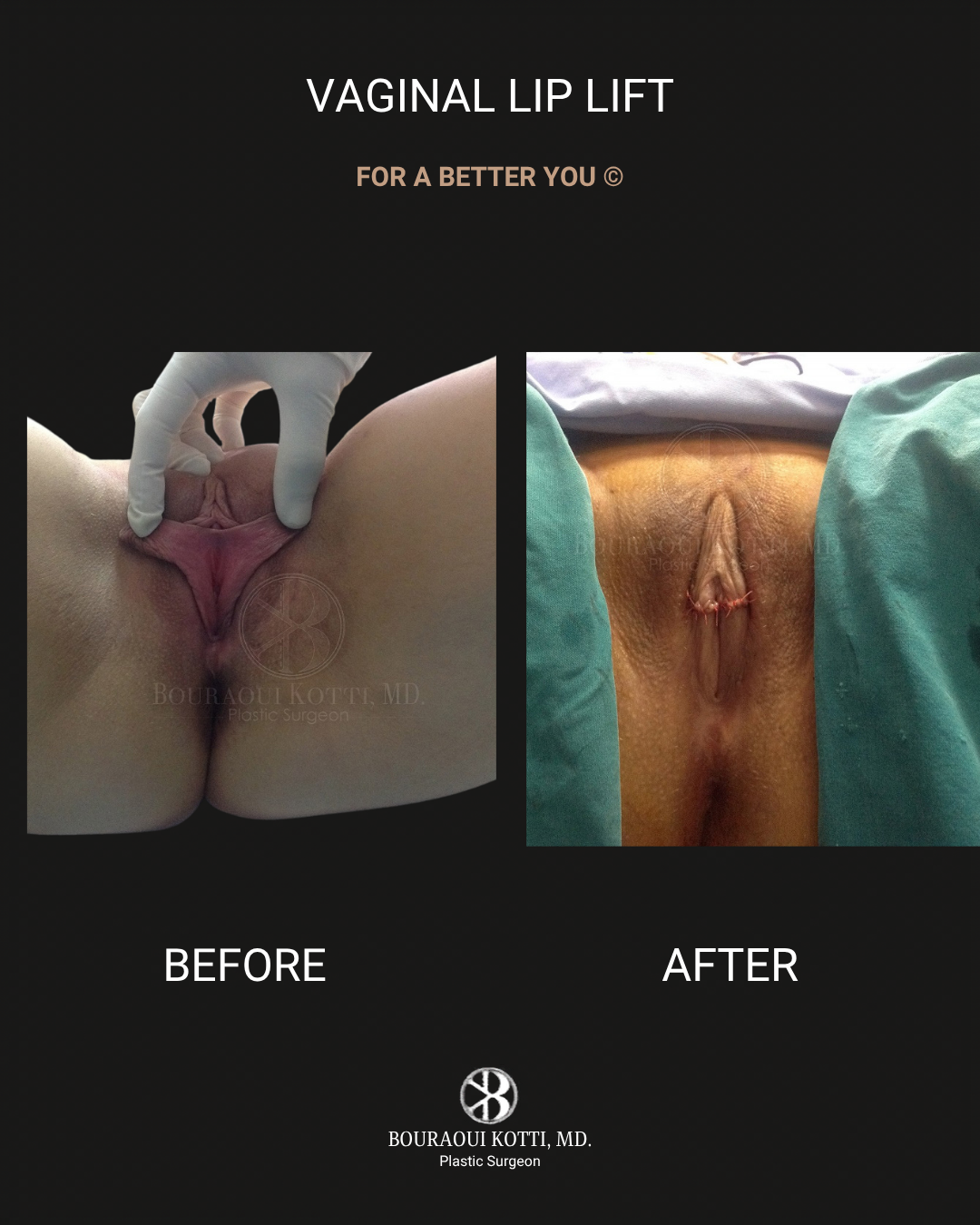 Labiaplasty in Dubai before Dubai