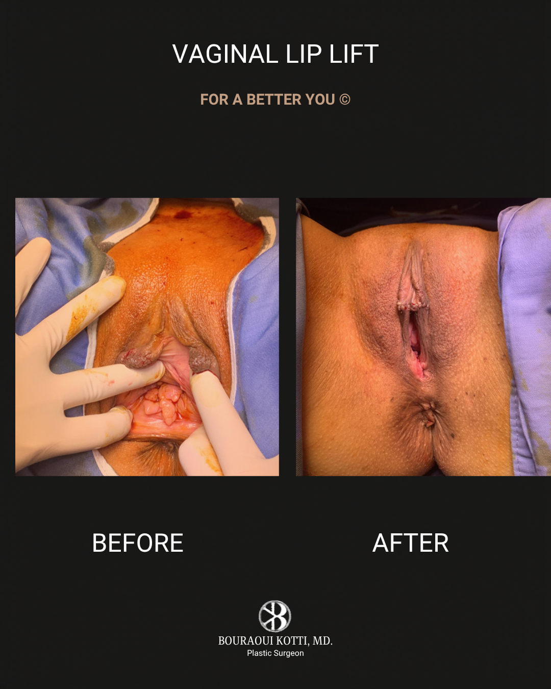 Labiaplasty in Dubai after Dubai
