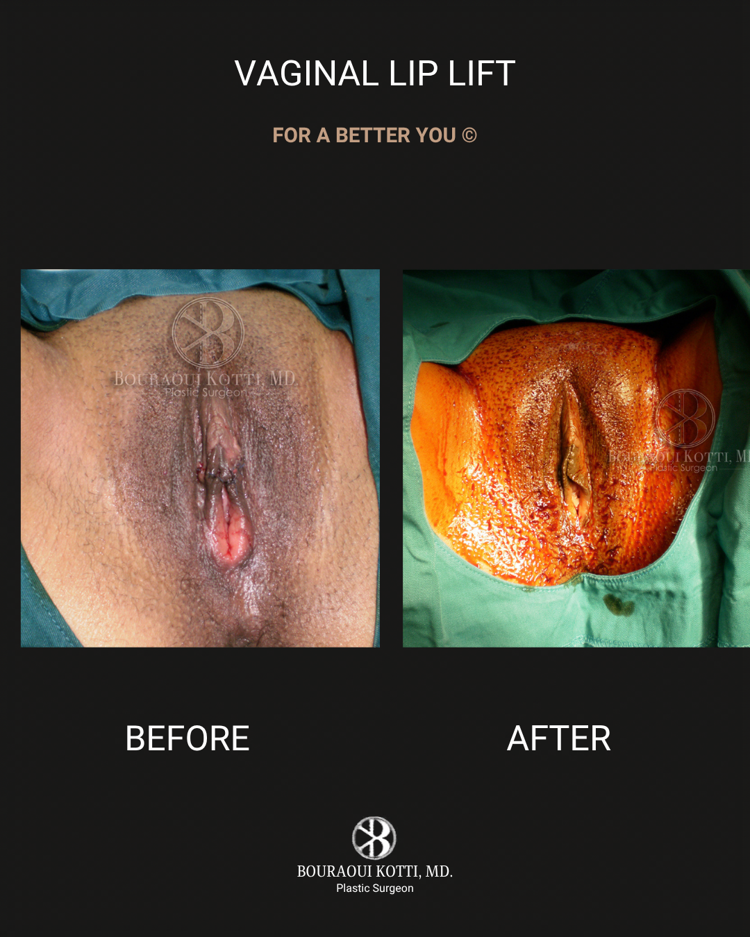 Labiaplasty in Dubai before Dubai