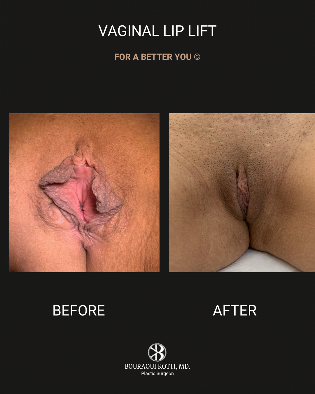 Labiaplasty in Dubai before Dubai