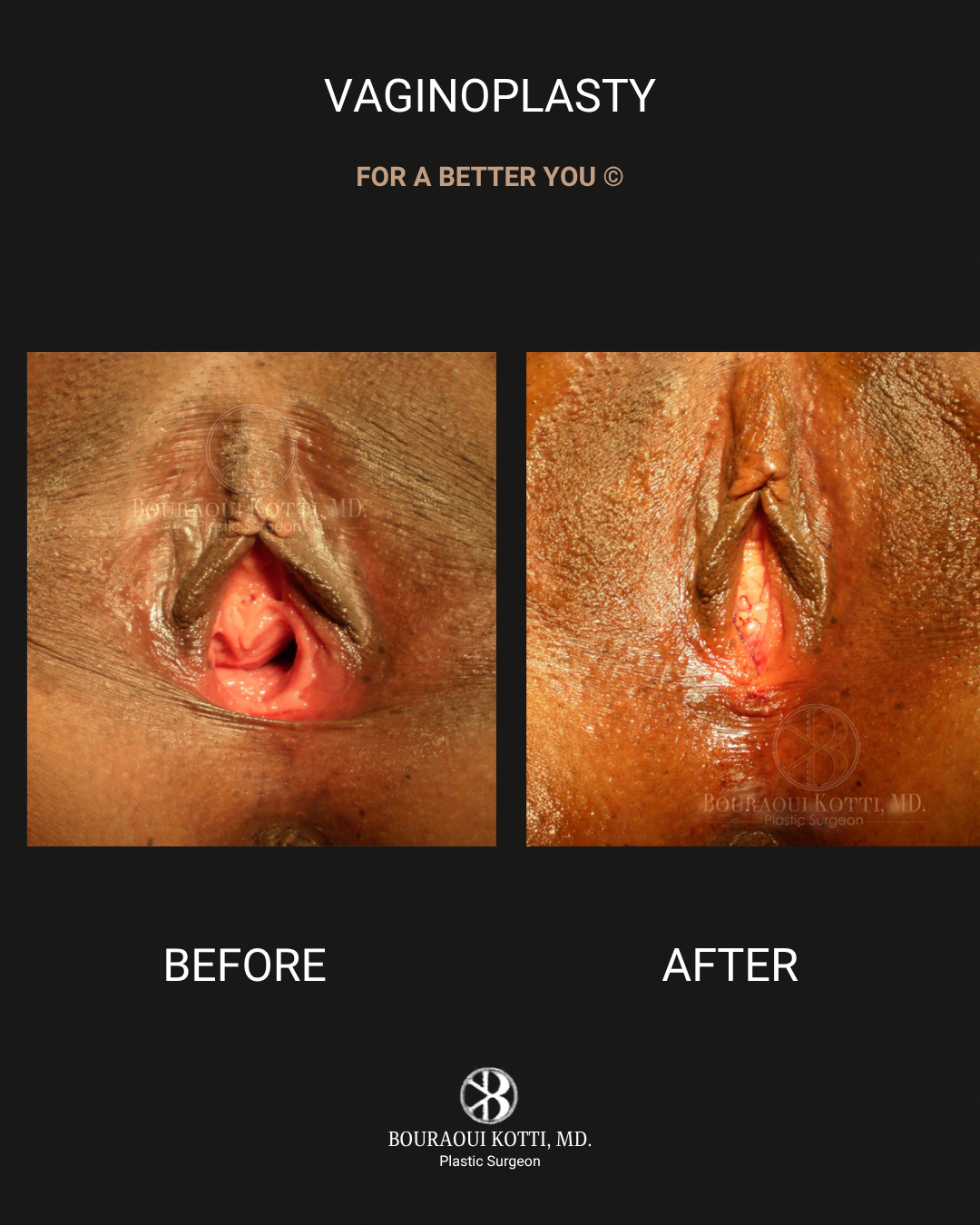 Labiaplasty in Dubai after Dubai