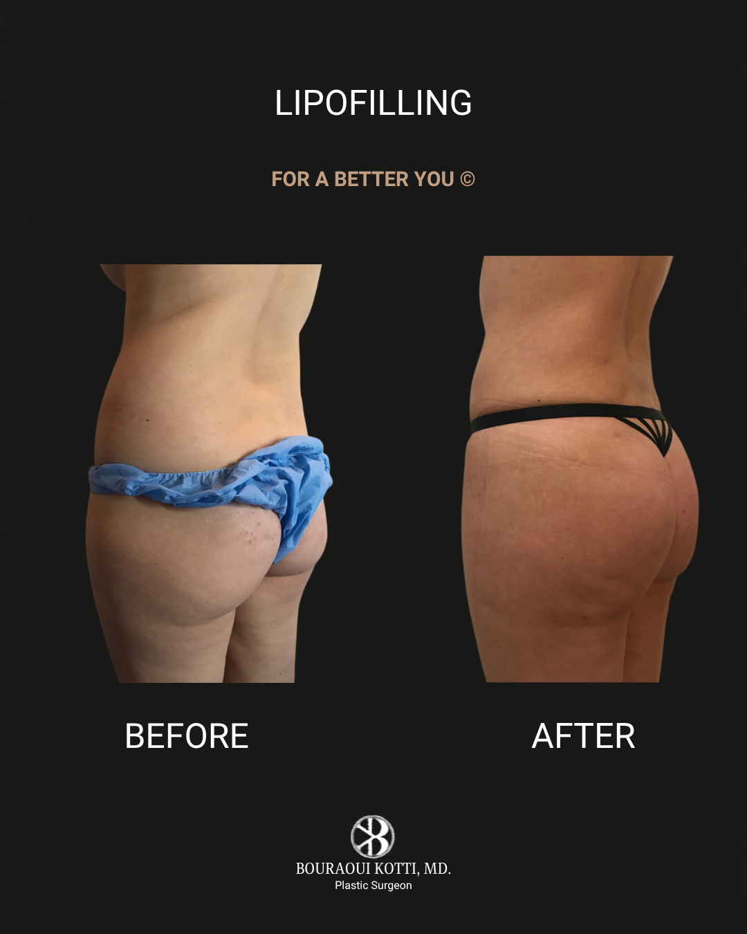 Lipofilling & Brazilian Butt Lift (BBL) before Dubai
