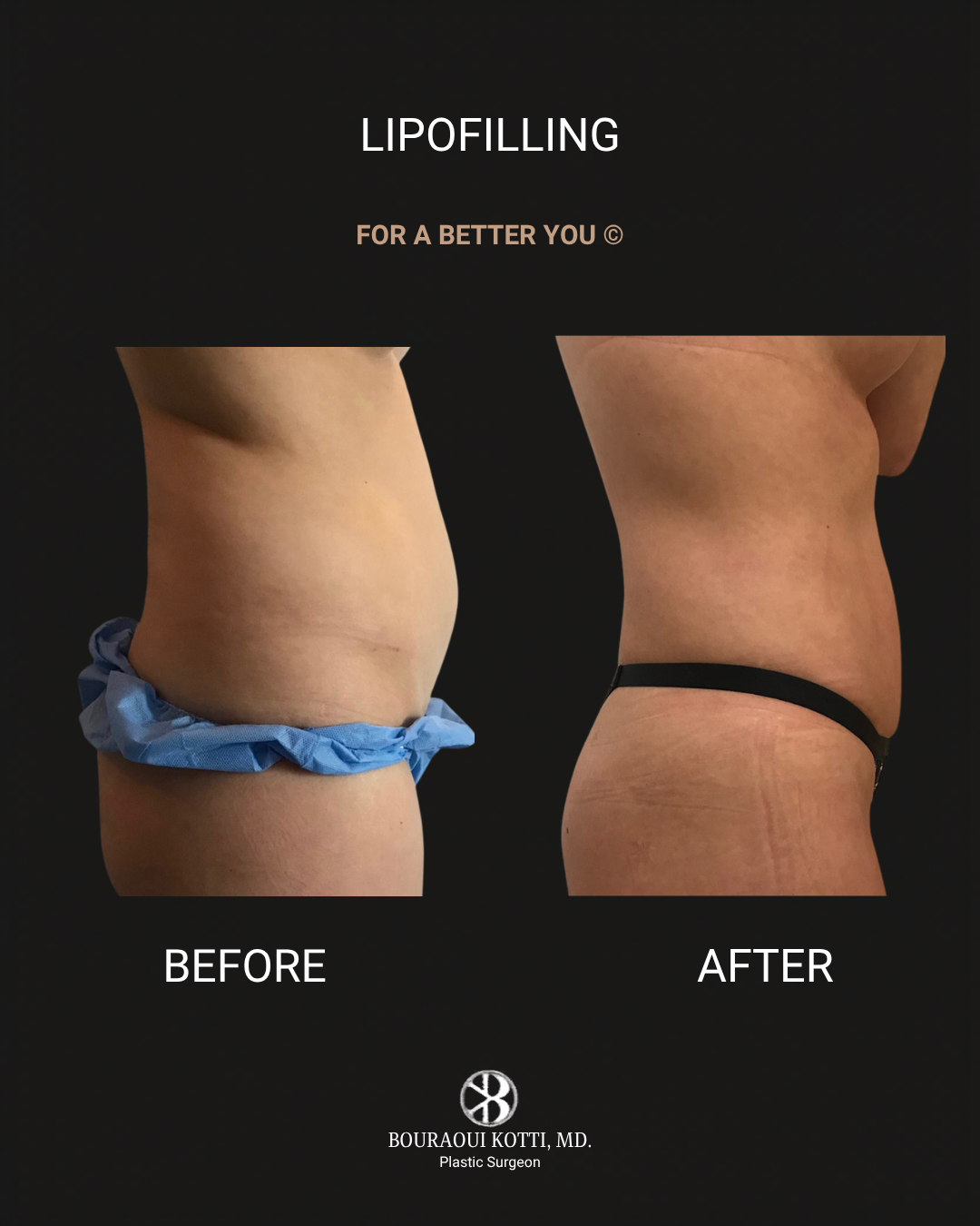 Lipofilling & Brazilian Butt Lift (BBL) after Dubai