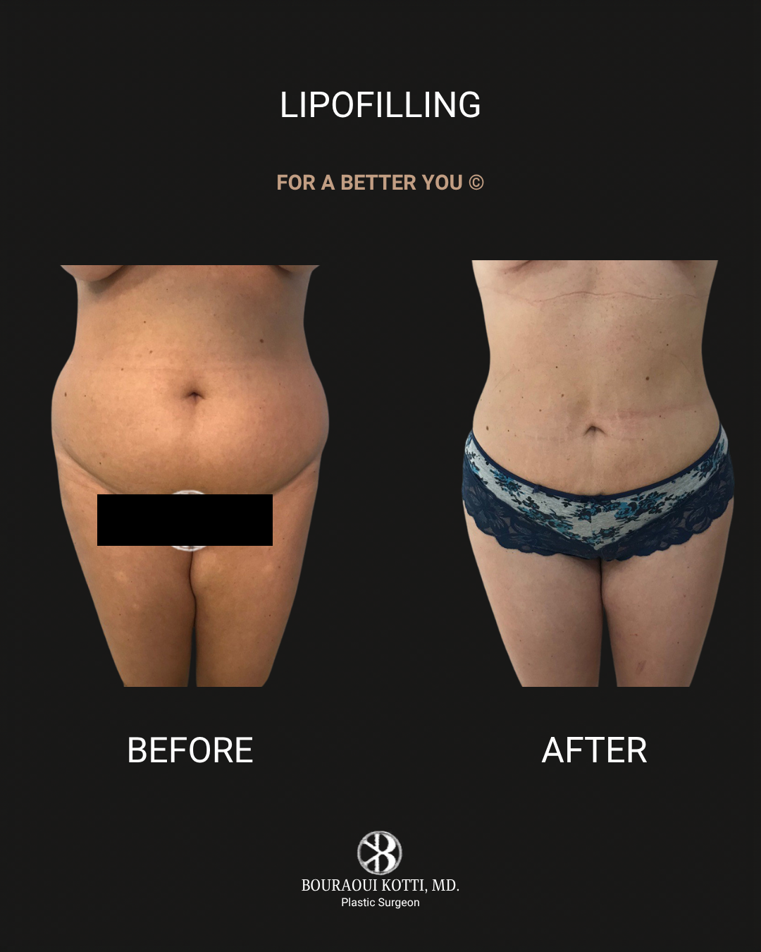 Lipofilling & Brazilian Butt Lift (BBL) before Dubai