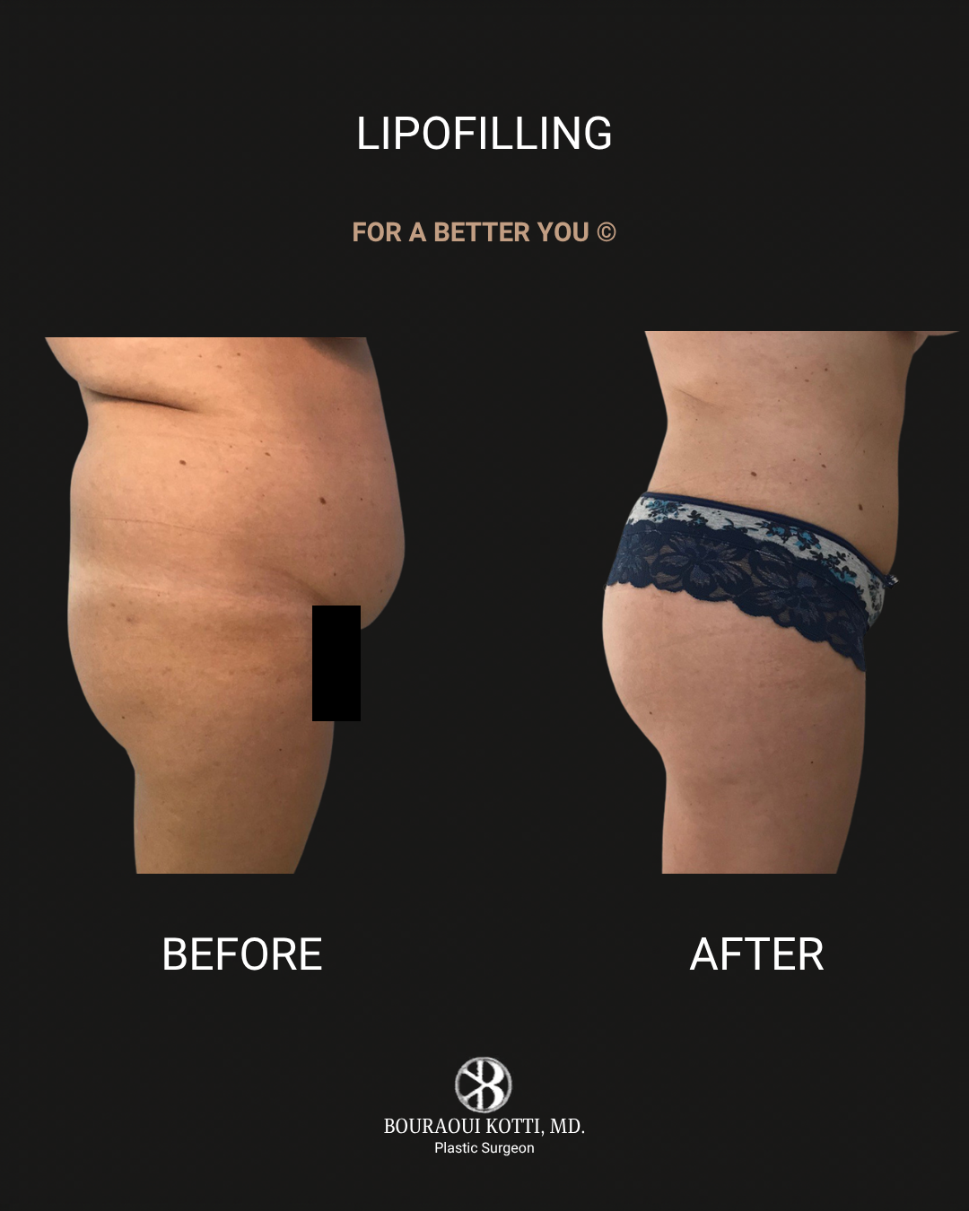 Lipofilling & Brazilian Butt Lift (BBL) after Dubai