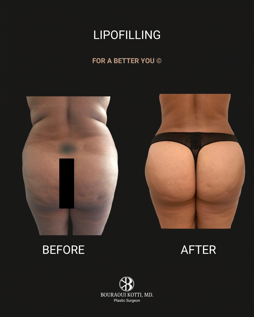 Lipofilling & Brazilian Butt Lift (BBL) before Dubai