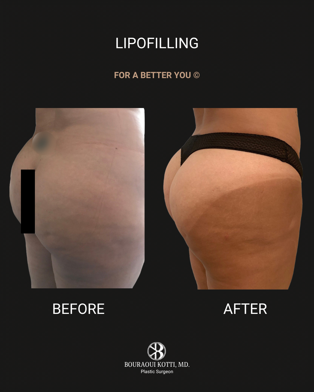 Lipofilling & Brazilian Butt Lift (BBL) after Dubai