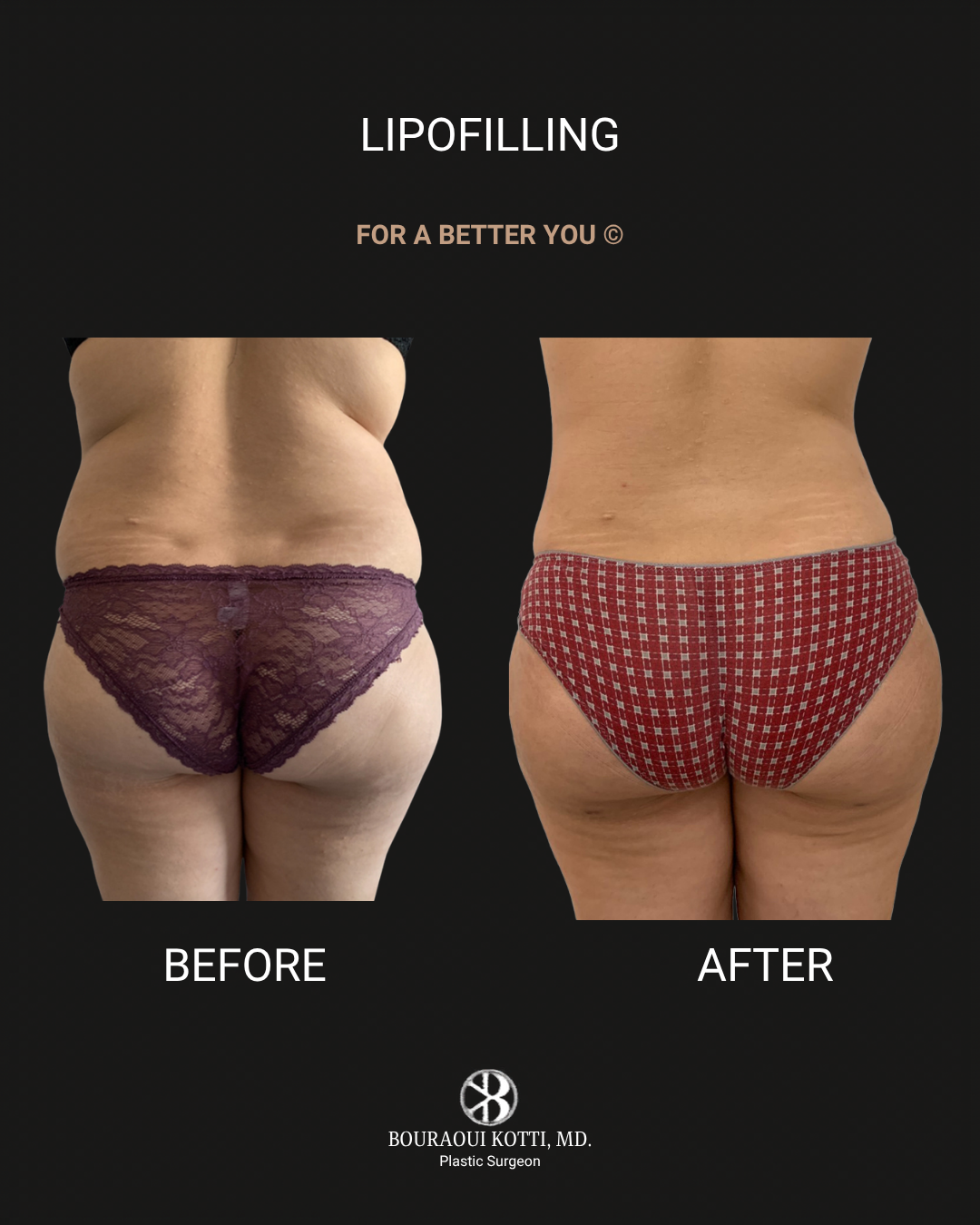 Lipofilling & Brazilian Butt Lift (BBL) before Dubai