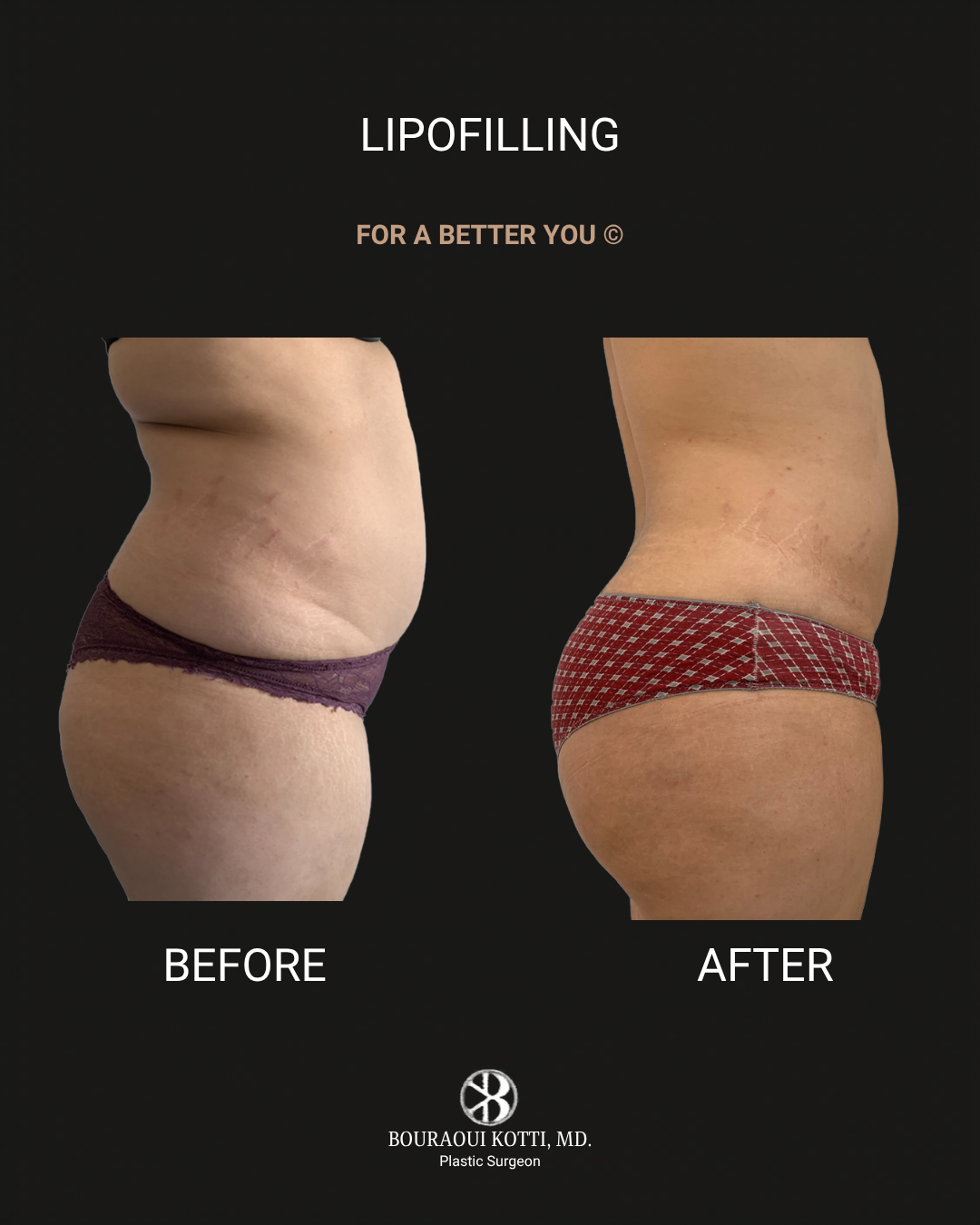 Lipofilling & Brazilian Butt Lift (BBL) after Dubai