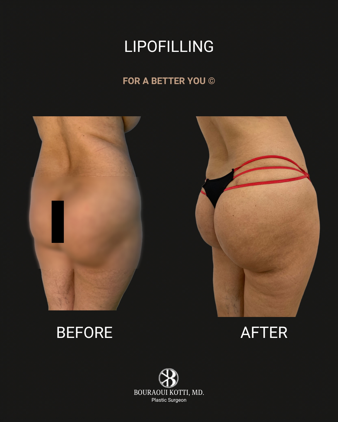 Lipofilling & Brazilian Butt Lift (BBL) before Dubai