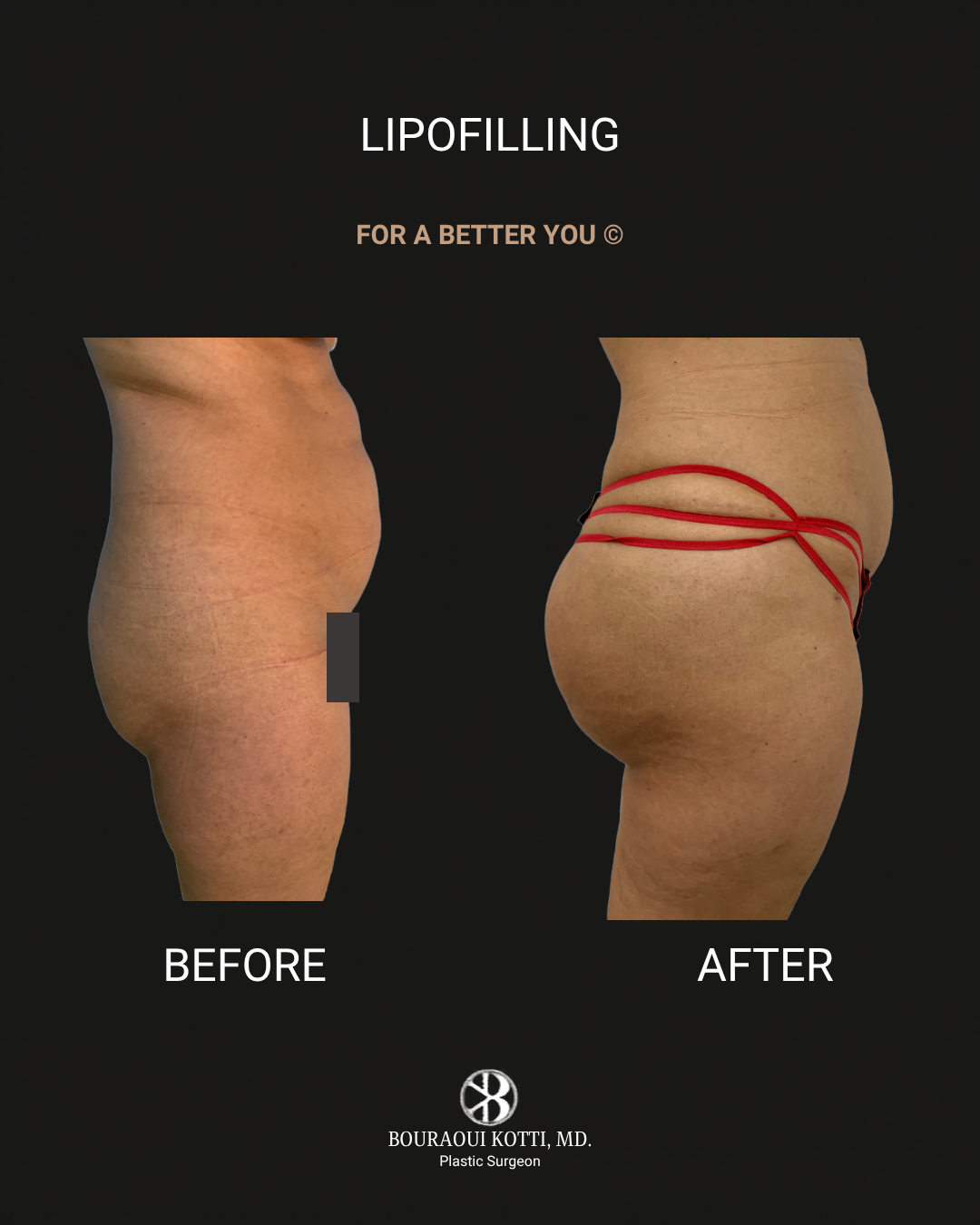 Lipofilling & Brazilian Butt Lift (BBL) after Dubai