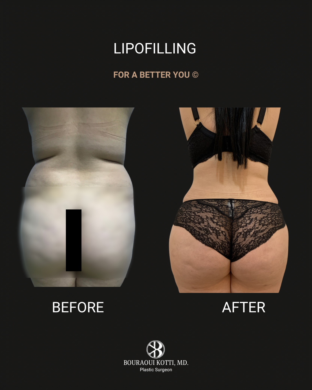Lipofilling & Brazilian Butt Lift (BBL) before Dubai