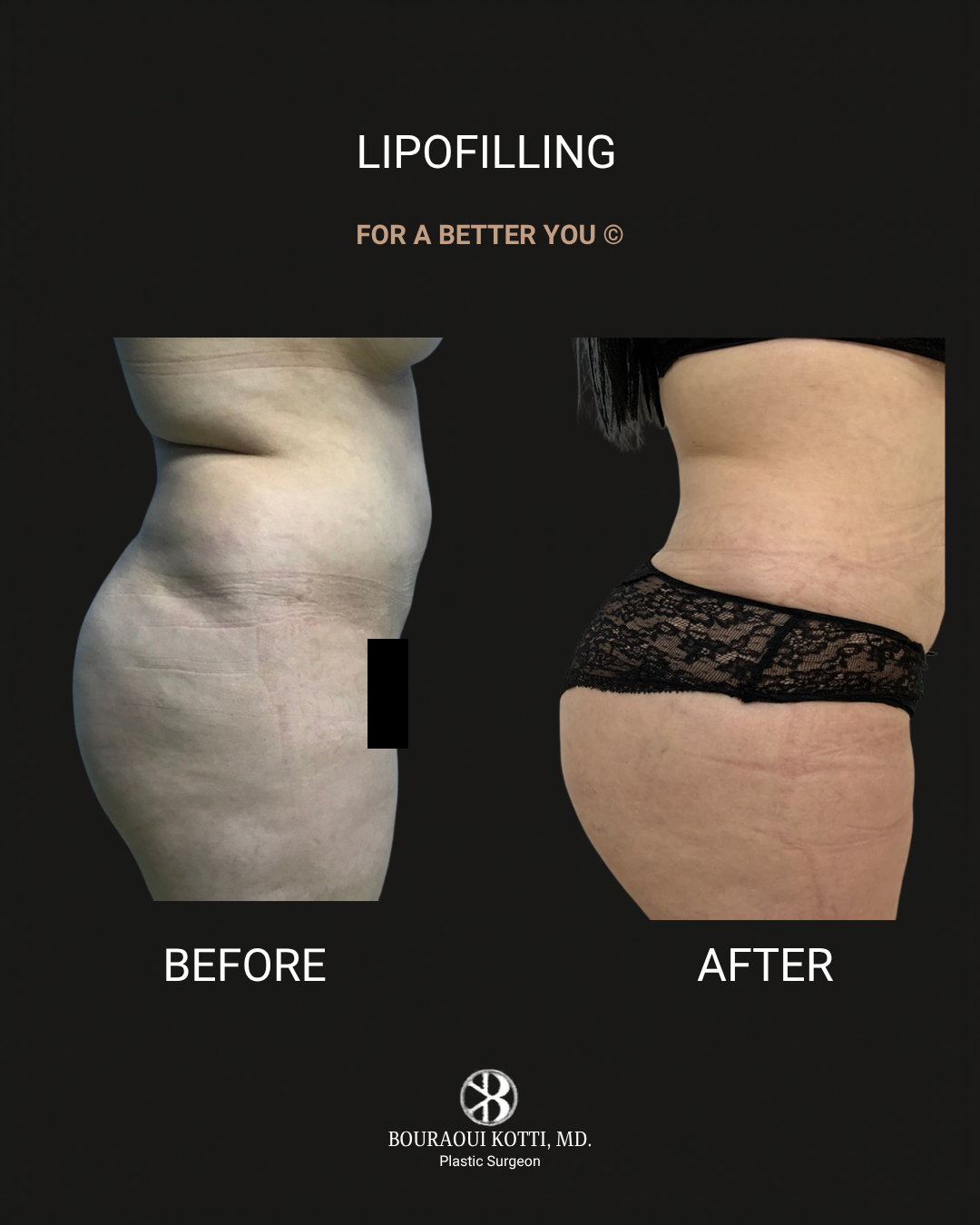 Lipofilling & Brazilian Butt Lift (BBL) after Dubai