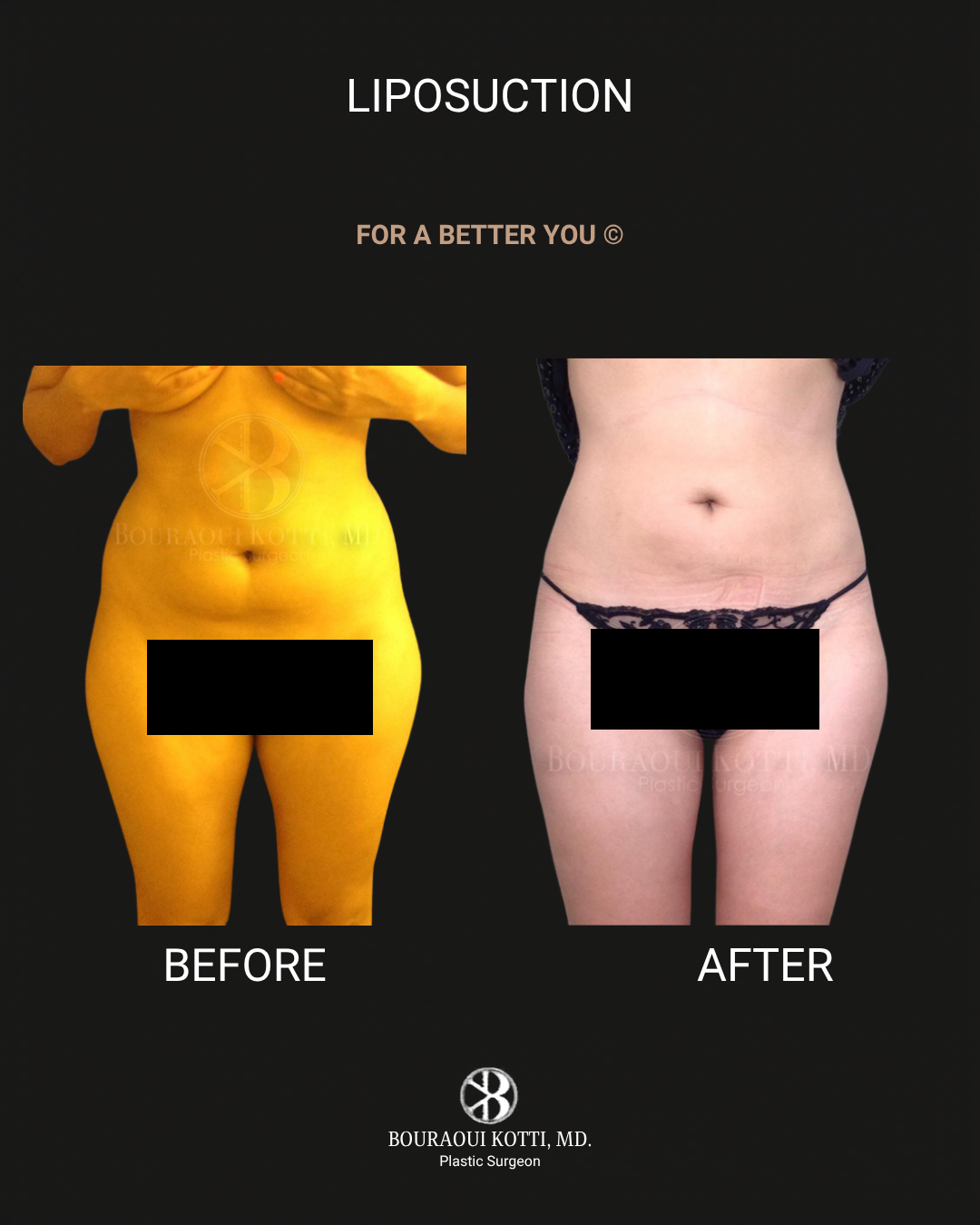Liposuction & Liposculpture before Dubai