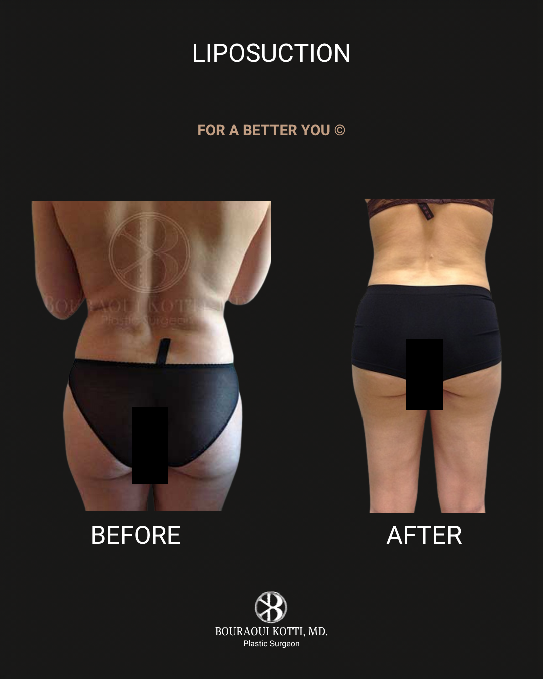 Liposuction & Liposculpture before Dubai