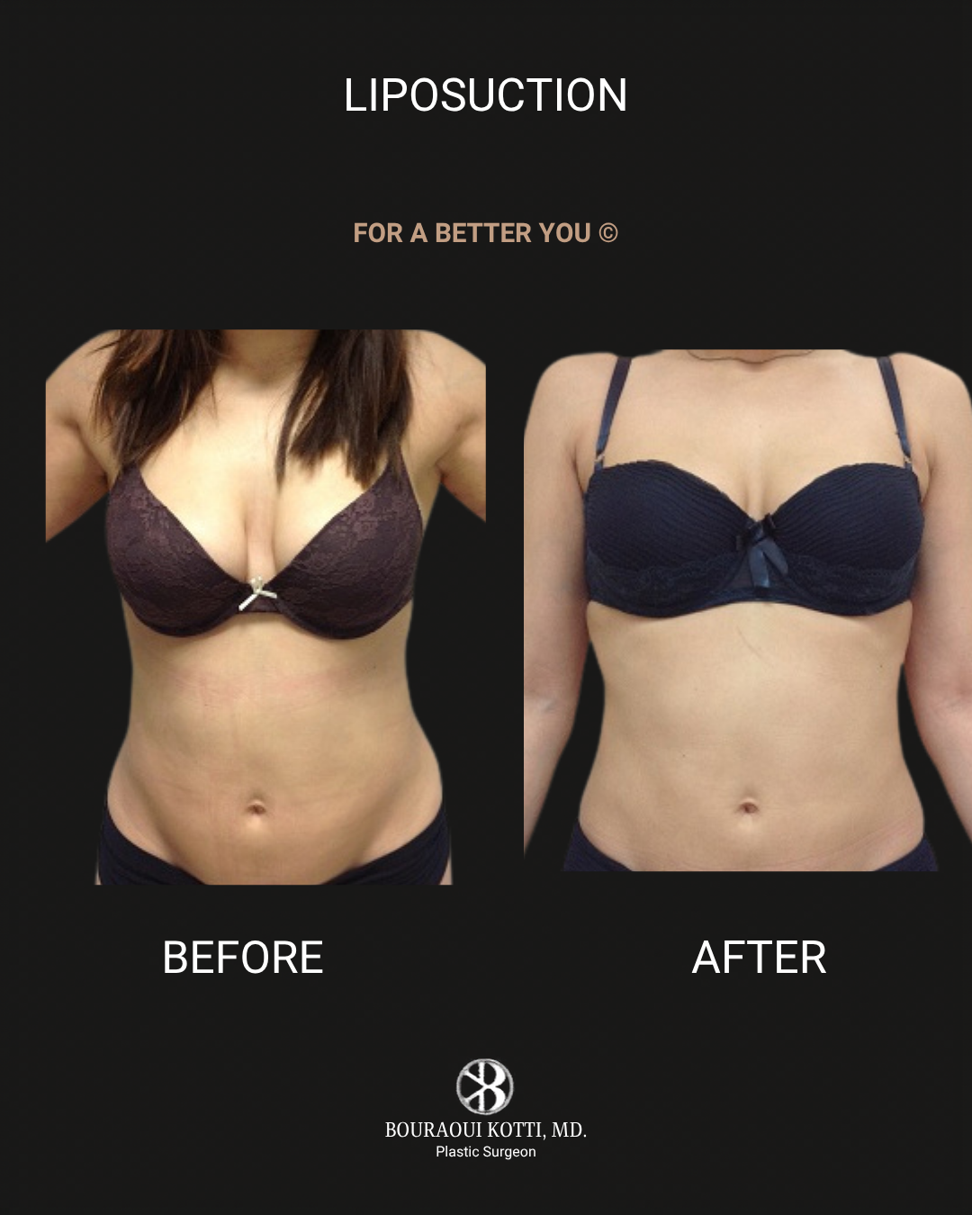 Liposuction & Liposculpture after Dubai