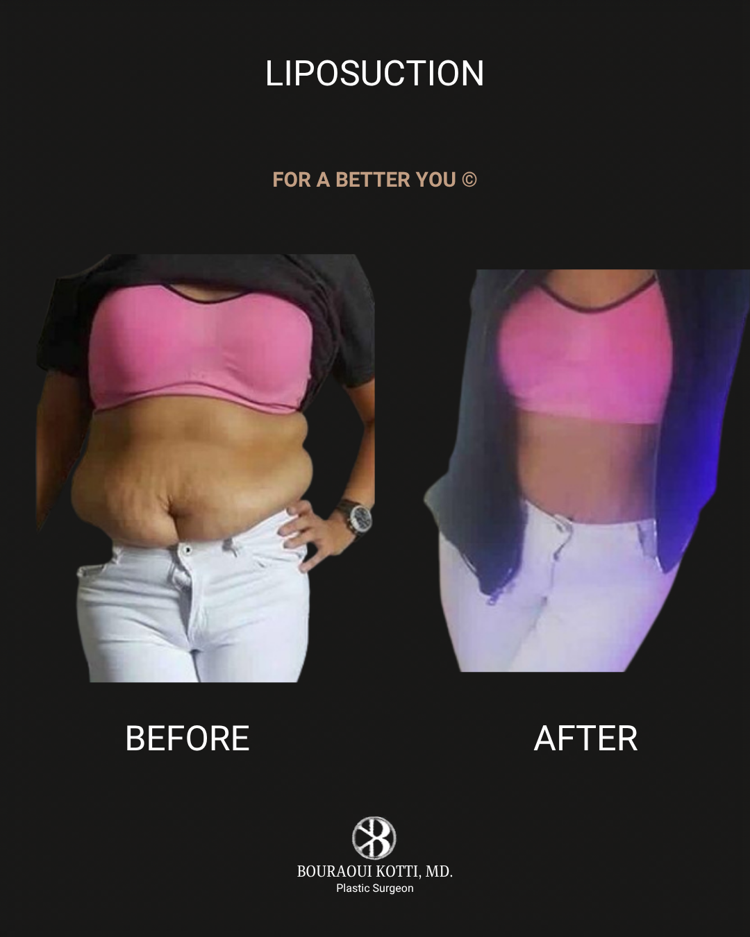 Liposuction & Liposculpture before Dubai