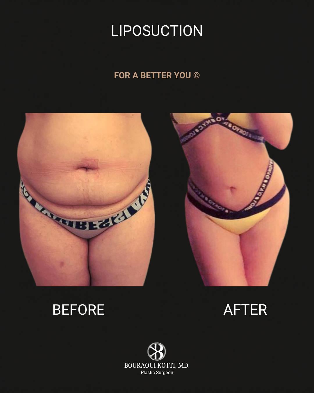 Liposuction & Liposculpture before Dubai