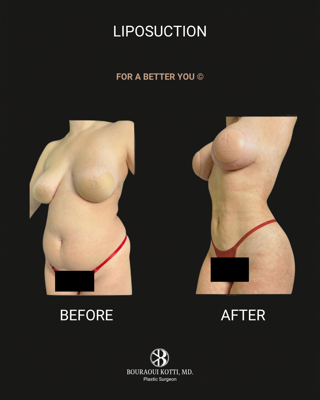 Liposuction & Liposculpture after Dubai