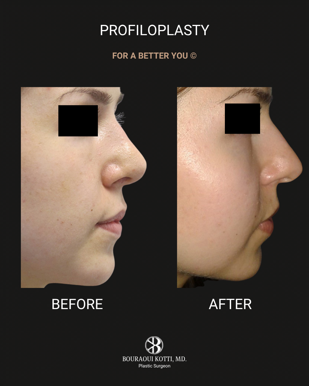 Profiloplasty — Non-Surgical Facial Contouring before Dubai