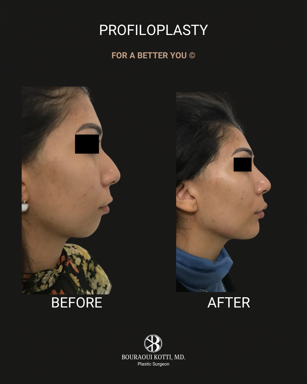 Profiloplasty — Non-Surgical Facial Contouring after Dubai