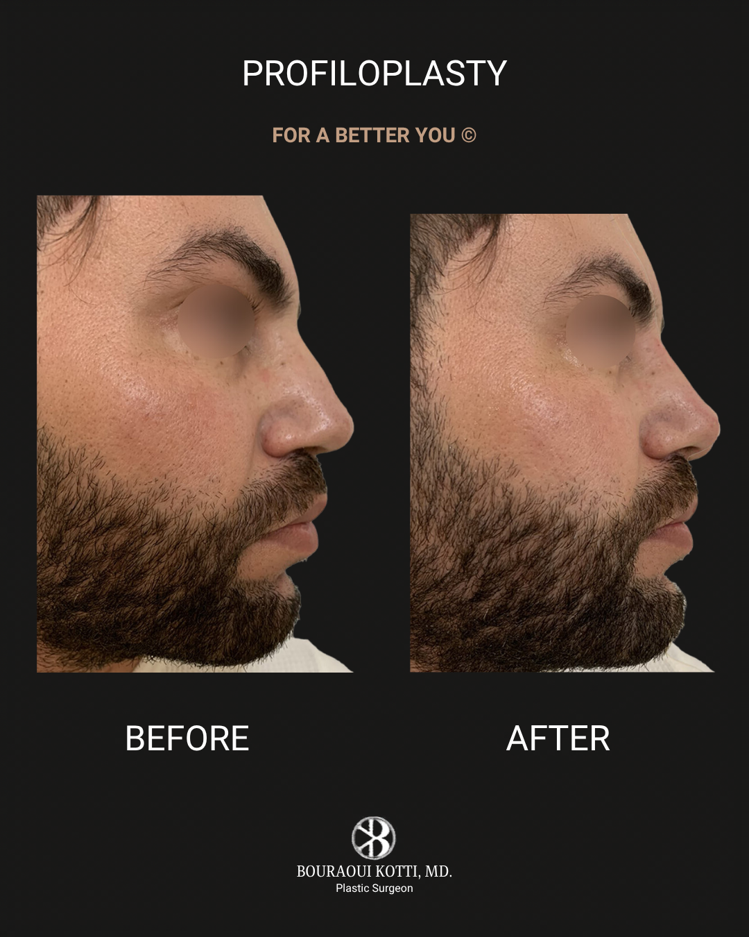 Profiloplasty — Non-Surgical Facial Contouring before Dubai
