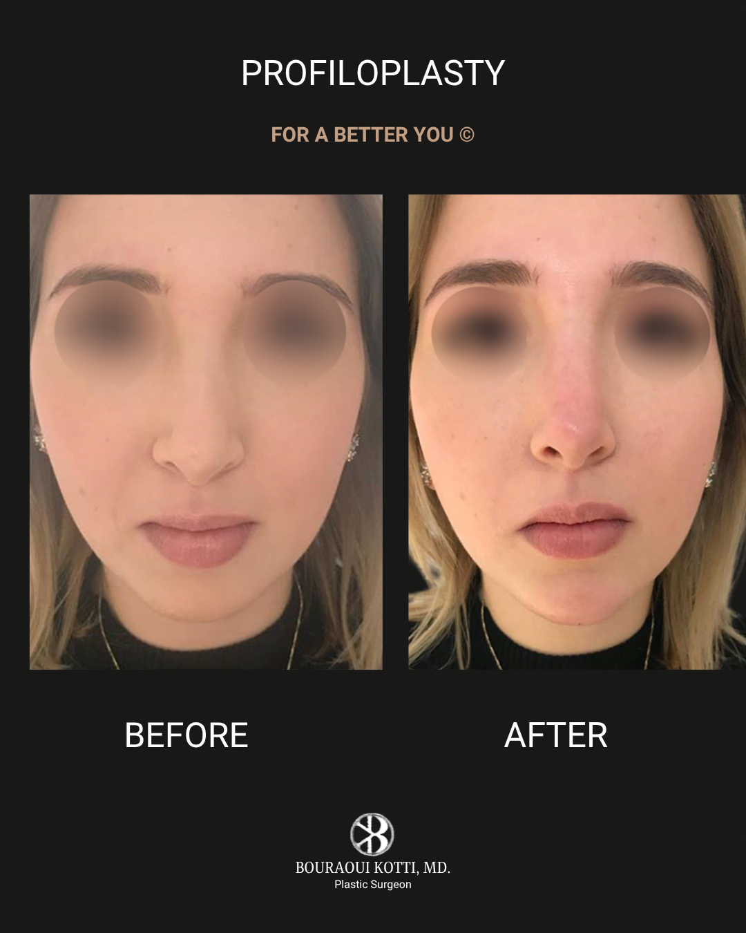 Profiloplasty — Non-Surgical Facial Contouring after Dubai
