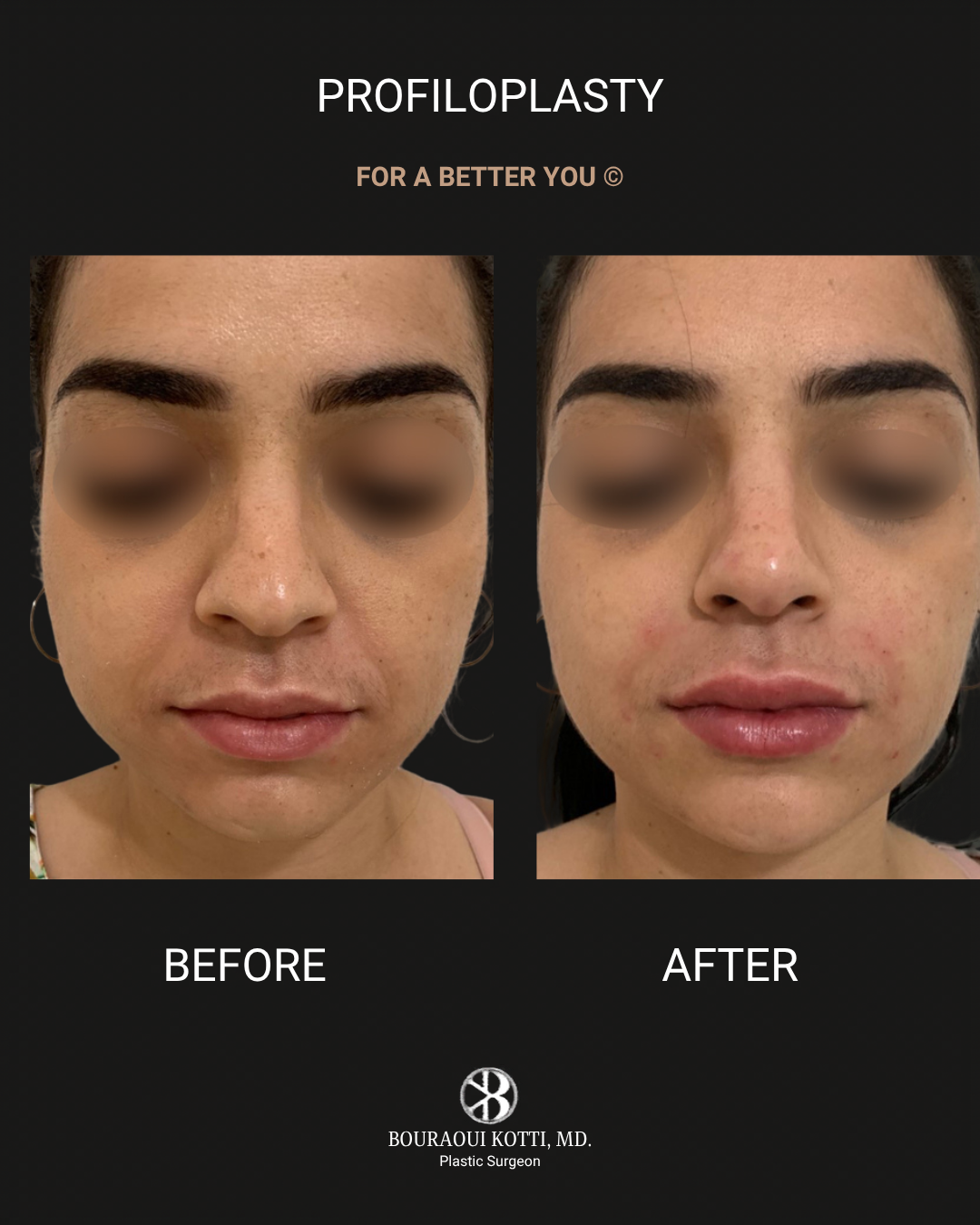 Profiloplasty — Non-Surgical Facial Contouring before Dubai