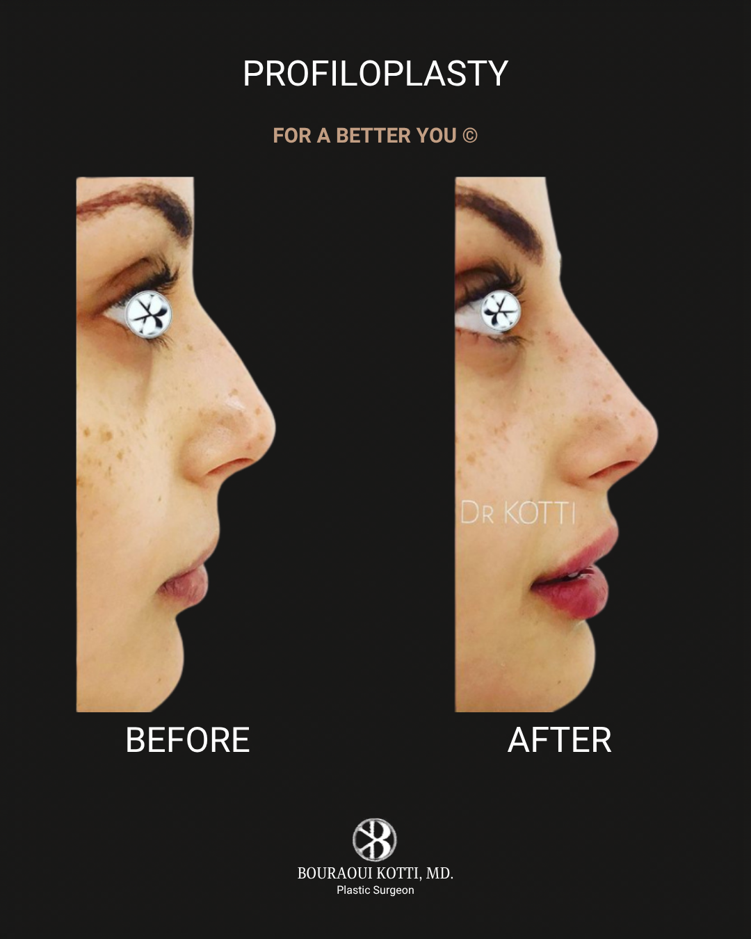 Profiloplasty — Non-Surgical Facial Contouring after Dubai